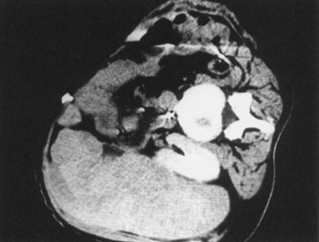 FIG 67-92, Significant hemorrhage can have numerous causes. This scan shows a large hematoma outlining the capsule of the liver in the lower portion of the abdomen, caused by a single pass of a 20-gauge Chiba needle (performed by the author). The patient has diffuse metastatic renal cell carcinoma to the liver that was very vascular.