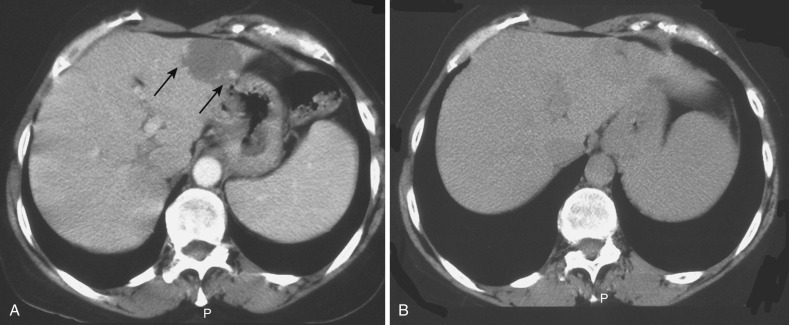 FIG 67-93, Hemangioma is a common benign problem that has the potential for catastrophic bleeding. A, This CT scan was taken during the contrast phase and shows the characteristics of feeding vessels in the wall of the lesion (arrows). B, Late-phase CT scan shows the mass to be completely homogeneous in the delayed phase. These qualities are pathognomonic, and no procedure should be performed.