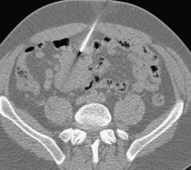 FIG 67-12, CT scan shows the choice of a pathway that avoids adjacent loops of bowel, permitting cutting needle biopsy of the mesenteric mass.