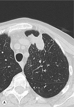 Fig. 81.5, A Coaxial System Has Been Used So There Is Only One Pass Through the Pleura During Lung Biopsy.