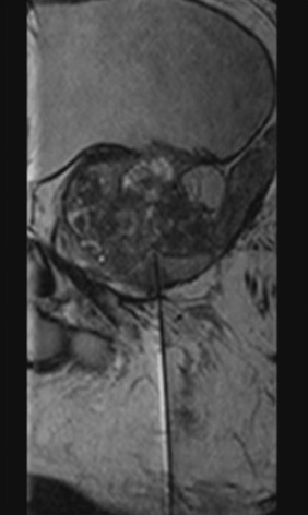 Fig. 81.6, Magnetic Resonance (MR)-Guided Biopsy of the Prostate.