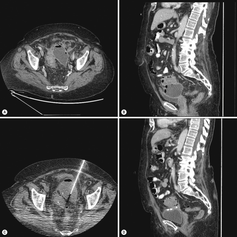 Fig. 82.1, Computed Tomography (CT)-Guided Drainage of a Diverticular Abscess Using the Seldinger Technique in a 59-Year-Old Male.