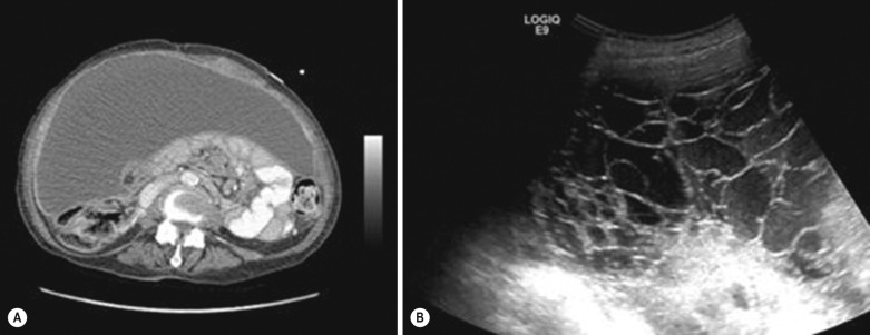 Fig. 82.2, Computed tomography (CT) and ultrasound in a 76-year-old female patient with metastatic ovarian carcinoma. (A) CT demonstrating a large volume of tense-appearing ascites; (B) Subsequent ultrasound demonstrates the complexity and loculation of this fluid, which is not appreciated with CT.