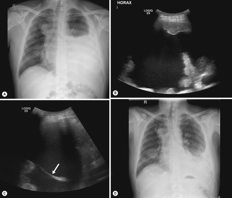 Fig. 82.3, Bedside ultrasound drainage of a large symptomatic pleural effusion in a 45-year-old male with invasive follicular thyroid carcinoma. (A) Chest radiograph demonstrating a large left-side effusion with an associated large mass in the right superior mediastinum and hilar adenopathy. (B) Ultrasound at the patient's bedside demonstrating this large simple left-sided effusion and nodular pleural metastatic disease. (C) Ultrasound post-procedure demonstrating the catheter in an appropriate position (white arrow) . (D) Chest radiograph demonstrating good initial response to drainage.
