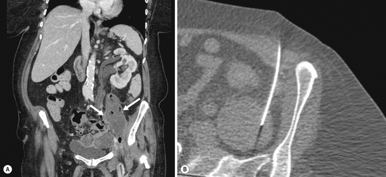 Fig. 82.4, Computed tomography (CT)-guided drain insertion in a 75-year-old female patient with a complex psoas abscess secondary to diverticular disease. (A) Coronal contrast-enhanced CT demonstrating an air-containing psoas abscess (white arrow) with adjacent inflamed sigmoid diverticular disease; note that this abscess is causing hydronephrosis in a left-sided duplex kidney. (B) Quick-check CT guidance is utilised to gain percutaneous access to this collection before drain insertion.