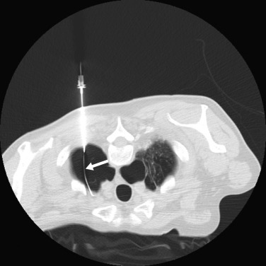 Fig. 82.6, Computed tomography-guided drainage of a pneumothorax after lung biopsy using the Seldinger technique. A 19-G needle has been inserted into the pneumothorax with an 0.035 guidewire advanced through this needle (white arrow) .