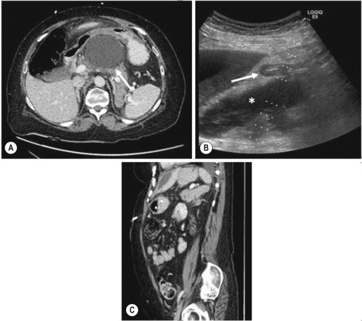 Fig. 82.7, Ultrasound-guided transgastric pancreatic pseudocyst drainage in a 48-year-old male patient. (A) Axial contrast-enhanced computed tomography (CT) demonstrating a large symptomatic pseudocyst displacing the lesser curve of the stomach 2 months after an initial presentation with pancreatitis. (B) Ultrasound demonstrating a transgastric route (white arrow) to this pseudocyst (white asteriks) . (C) Follow-up contrast-enhanced sagittal CT demonstrating retraction of the drain into the stomach.