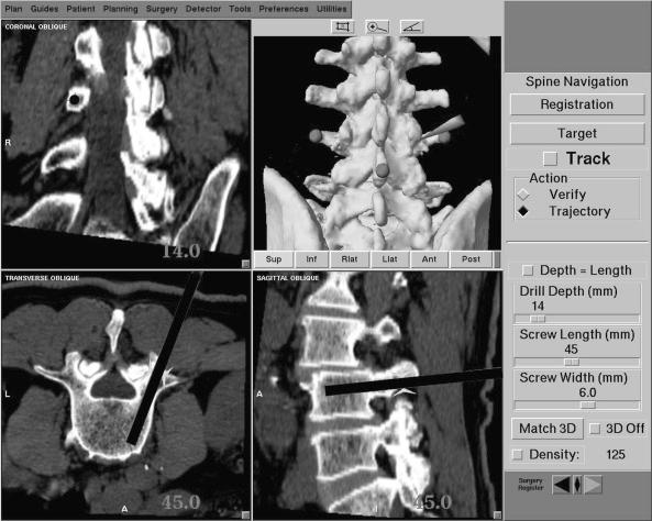 FIGURE 46-1, Workstation screen demonstrating navigation for an L3 pedicle screw using a computed tomography–based navigation system.