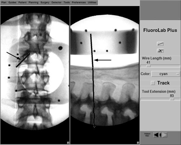 FIGURE 46-2, Workstation screen of a fluoroscopic navigational system. Standard anteroposterior and lateral views are provided with superimposed trajectory lines ( arrows ).
