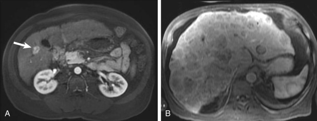 Figure 86-1, Tumor staging in selection of appropriate loco-regional treatment strategy in two patients. A, Axial gadolinium-enhanced magnetic resonance imaging (MRI) demonstrates a 2.1-cm arterially enhancing hepatocellular carcinoma (HCC) (arrow) in a 53-year-old man that was treated with radiofrequency ablation. B, Axial gadolinium-enhanced MRI in the portal venous phase demonstrates multiple lesions in both lobes of liver (biopsy-proved HCC) in a 79-year-old man that was treated with transarterial chemoembolization.