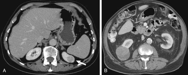 Figure 86-2, Solitary renal cell carcinoma (RCC) treated by percutaneous ablation. A, Axial nephrographic phase computed tomography (CT) demonstrates a 2.3-cm left upper pole RC (arrow) in a 72-year-old man treated with cryoablation. B, Axial nephrographic phase CT demonstrates a 4.5-cm right renal mid-pole RCC (arrow) in a 62-year-old woman treated with radiofrequency ablation with multiple sessions.