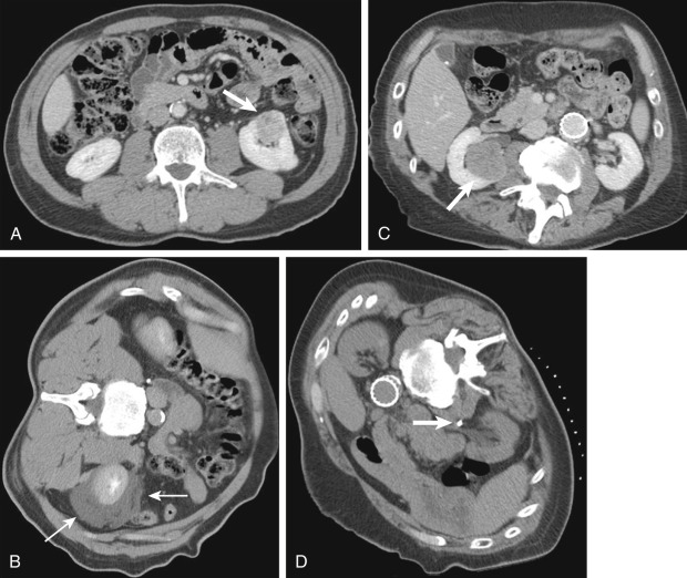 Figure 86-3, Tumor location and its impact on planning procedural strategy for percutaneous ablation. A, Axial nephrographic phase computed tomography (CT) image shows a 2.9-cm left renal cell carcinoma (RCC) (arrow) in the anterior aspect with close proximity to the colon. B, Intraprocedural axial CT images showing instillation of peritoneal 5% dextrose solution to move the colon away (hydrodissection) from the kidney to facilitate successful radiofrequency ablation of the renal lesion (arrows). C, Axial nephrographic phase CT image shows a 3.6-cm central RCC (arrow) with close proximity to the renal pelvis and ureter. D, Intraprocedural axial CT image shows the ureter placed (arrow) for pyeloperfusion technique to limit collecting system injury.