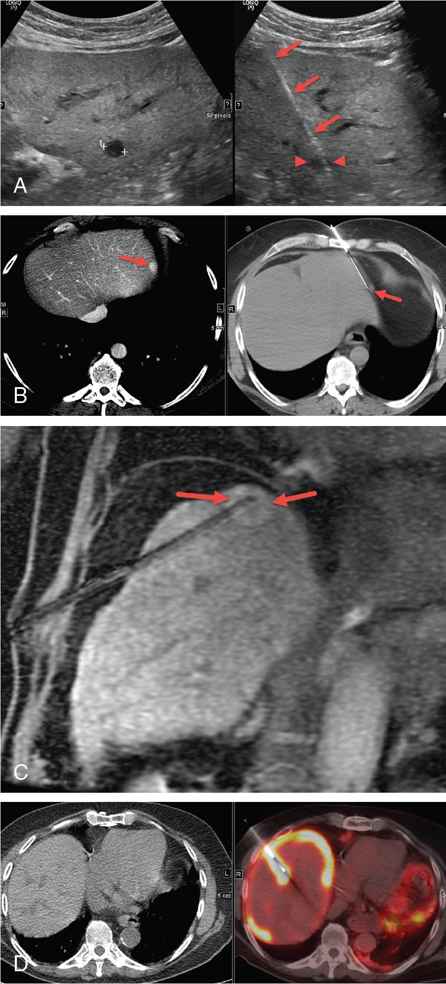 FIGURE 23.2, Image-guided liver biopsy.