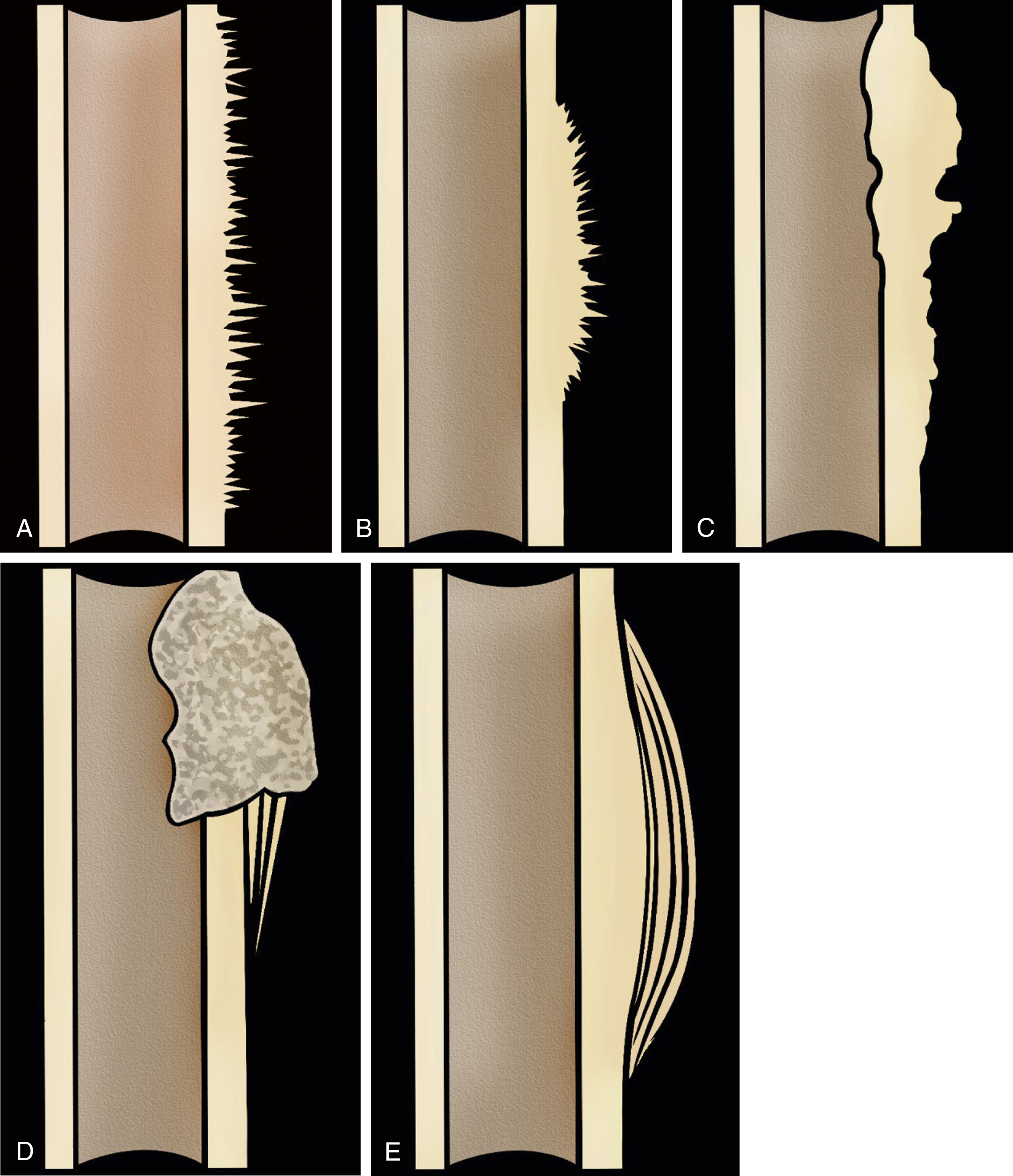 Fig. 14.3, Aggressive forms of periosteal reaction: (A) spiculated/hair-on-end; (B) spiculated/sunburst; (C) disorganized; (D) Codman triangle; and (E) lamellated/onion skin.