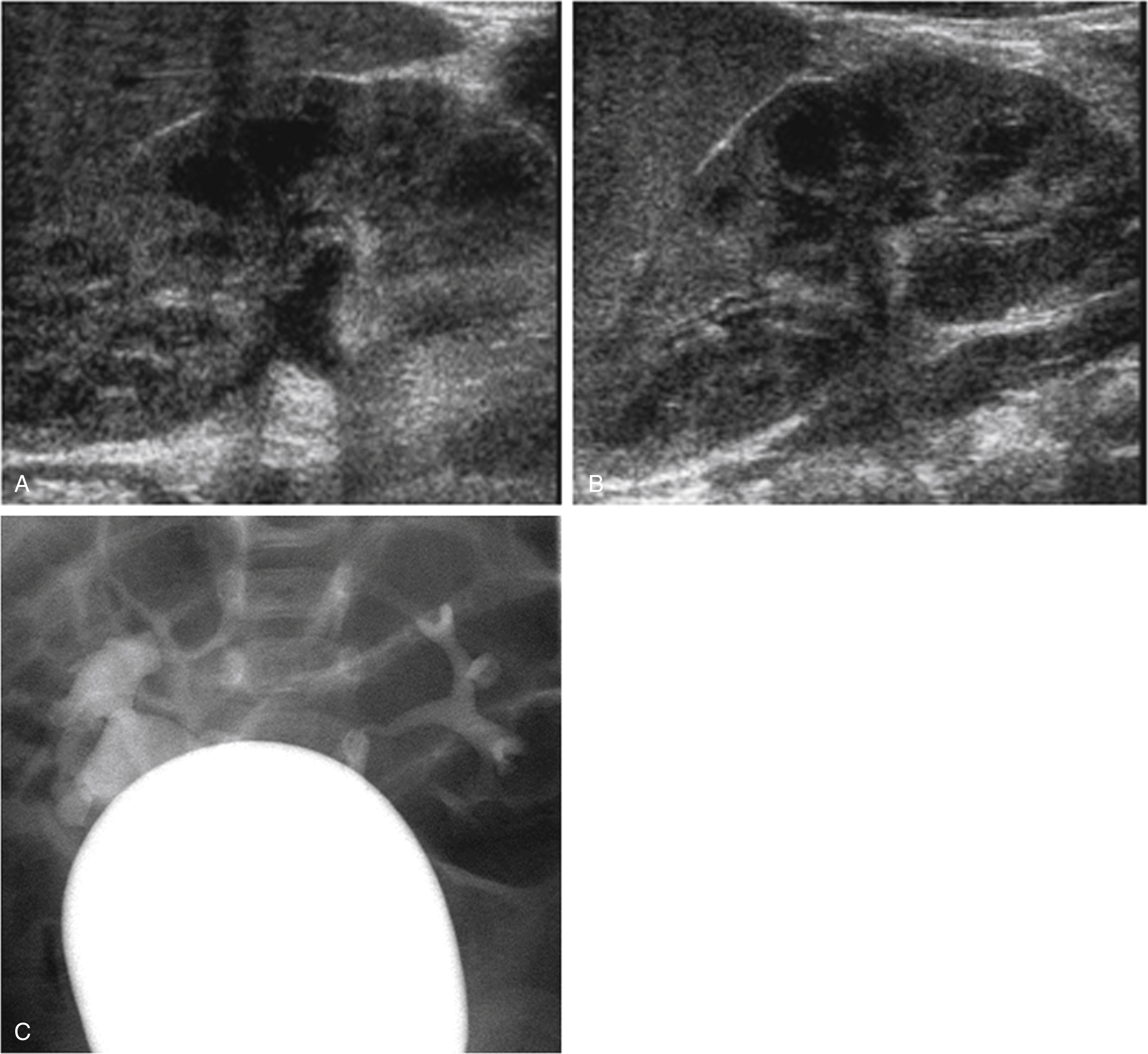 Fig. 8.6, (A–C) A normal ultrasound does not exclude reflux. Reflux is an intermittent process. Although reflux may cause urinary tract dilation, when there is no reflux, the urinary tract may appear normal. This patient had a febrile urinary tract infection. His renal and bladder ultrasound appeared normal (A, B). The voiding cystourethrogram (C) shows right grade 3 vesicoureteral reflux and left grade 2 vesicoureteral reflux.