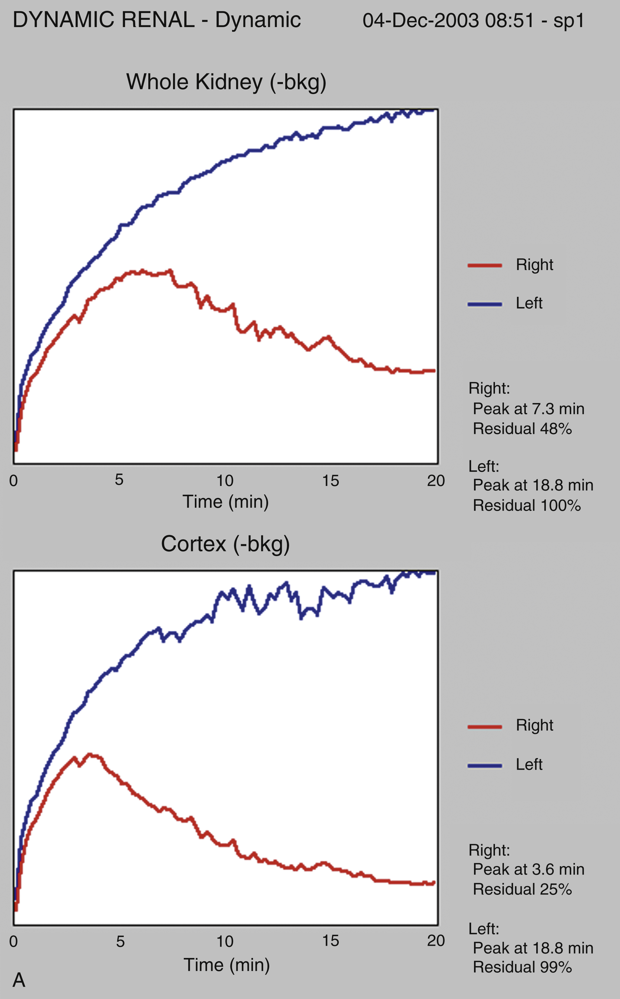 Fig. 8.10, (A, B) Mercaptoacetyltriglycine (MAG3) study shows obstruction as evidenced by delayed excretion of contrast and abnormal emptying of the urinary tract after diuresis in the left kidney compared to the normal right kidney.