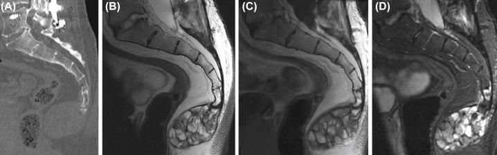 Figure 8.1, Typical imaging characteristics of a coccygeal chordoma. The sacrum and coccyx are common locations for spinal chordoma. A sagittal CT image (A) demonstrates lytic destruction of the coccyx. Sagittal T2-weighted (B), sagittal T1-weighted pregadolinium (C), and sagittal T1-weighted postgadolinium fat-suppressed (D) images demonstrate a heterogeneous soft-tissue mass with internal fluid levels and septations.