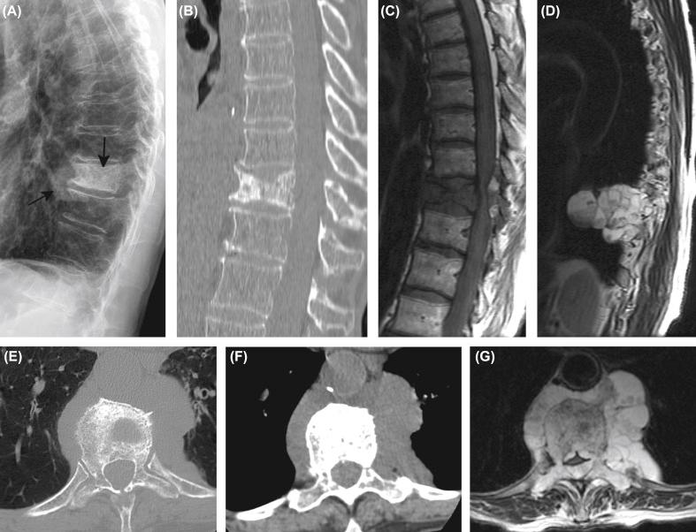 Figure 8.2, Imaging characteristics of a thoracic spine chordoma. A lateral chest radiograph (A) shows a lesion with a soft-tissue component and a sclerotic vertebral body component ( arrows ). A sagittal CT image in bone window (B) and a sagittal T1-weighted MR image (C) better characterize the extent of bone involved. The paravertebral soft-tissue component seen on the radiograph is best characterized on a para-sagittal T2-weighted MR image (D). An axial CT image in bone window (E) demonstrates vertebral body sclerosis and coarsened trabeculation. An axial CT image in soft-tissue window (F) better characterizes the extent and internal density of the extra-vertebral soft-tissue component. An axial T2-weighted image of the tumor (G) shows internal lobulations with high T2 signal separated by septations with low T2 signal. The mass encroaches on the epidural space narrowing the spinal canal and compressing the spinal cord.