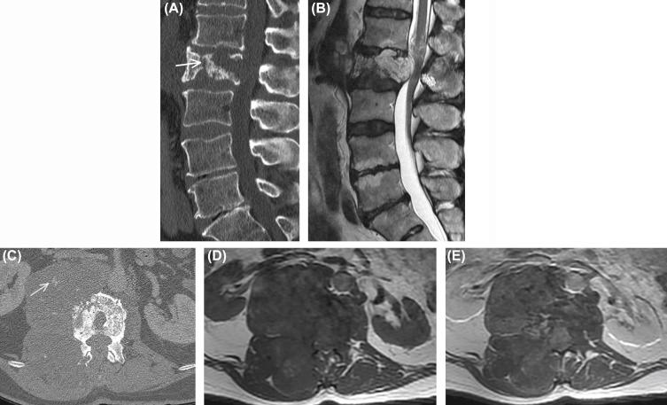 Figure 8.3, Imaging characteristics of a lumbar spine chordoma. The lumbar spine is an unusual location for spinal chordoma. A sagittal CT (A) image demonstrates a mixed sclerotic and lytic lesion with a pathologic fracture ( arrow ) and vertebral body collapse. The retropulsed vertebral body narrows the spinal canal and compresses the conus medullaris, seen best on sagittal T2-weighted imaging (B). Axial CT (C), axial T1-weighted pregadolinium (D), and axial T1-weighted postgadolinium (E) images show this chordoma has lobulated margins, internal heterogeneity, punctate fragments of lysed bone ( arrow ), and mild-to-moderate enhancement.