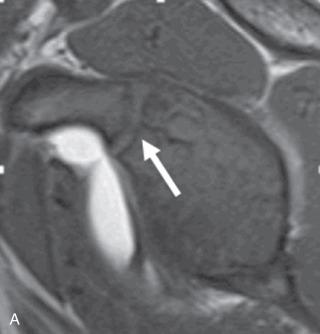 Fig. 132.1, (A) Sagittal T1 image shows the normal growth plate at the base of the coracoid (arrow) . (B) Coronal T1 fat-suppressed image shows the growth plate for the subcoracoid secondary ossification center (superior arrow) and inferior glenoid secondary ossification center (inferior arrow) . This should not be confused with a fracture following trauma.