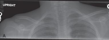 Fig. 132.2, (A) Anteroposterior radiograph of the bilateral clavicles shows a fracture of the distal right clavicle with widening of the coracoclavicular space. (B) Follow-up radiograph shows early periosteal new bone (arrows) related to the stripping of the periosteum, causing the elevated clavicle. The coracoclavicular ligaments are intact.