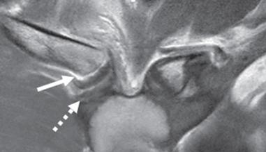 Fig. 132.3, Images from a 15-year-old boy injured playing football. Coronal non–fat-suppressed fluid-sensitive sequence demonstrates a fracture through the medial clavicular growth plate separating the metaphysis from the epiphysis, consistent with a Salter 1 fracture (arrow) . The fibrocartilaginous disk within the sternoclavicular joint (dashed arrow) and capsule remains intact.