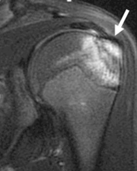 Fig. 132.5, Coronal fat-suppressed fluid-sensitive T2-weighted sequence shows an avulsion fracture (arrow) of the greater tuberosity in this skeletally immature patient. The bright signal within marrow relates to hemorrhage and edema associated with the fracture.