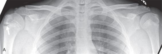 Fig. 132.6, (A) Anteroposterior radiograph of both shoulders shows widening of the right proximal humeral growth plate characteristic of “Little Leaguer shoulder.” (B) Widening of the growth plate (arrows) seen on a fat-suppressed fluid-sensitive sequence and (C) a non–fat-suppressed T1-weighted sequence.