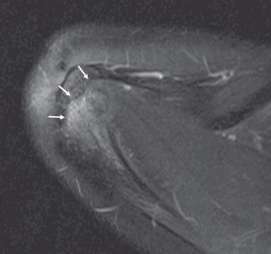 Fig. 132.7, Axial T2-weighted fluid-sensitive sequence from a 13-year-old patient demonstrates the normal arched configuration (arrows) of the distal acromial ossification center. Note the normal increased signal at the metaphysis, which is related to red marrow.