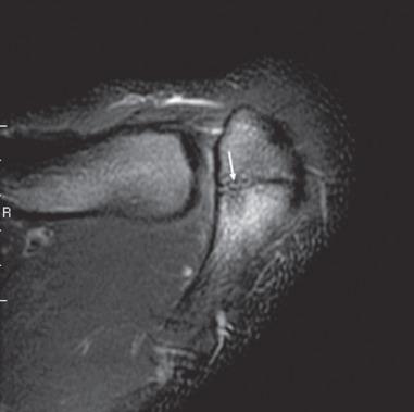 Fig. 132.8, Axial T2-weighted fluid-sensitive sequence from a 16-year-old patient shows a transverse interface perpendicular to the long axis of the acromion consistent with an os acromiale. Fluid signal (arrow) at the interface suggests instability of the ossicle and symptomatic os acromiale.