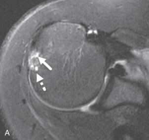 Fig. 132.9, Pathologic internal impingement. (A) Axial T2-weighted fluid-sensitive sequence from a 14-year-old boy shows a small articular side insertional tear of the infraspinatus tendon (arrow) as well as small cystic foci at the posterolateral humerus (dashed arrow) near the bare area. (B) Sagittal proton-density fat-suppressed sequence shows abnormal thickening of the posterior band of the inferior glenohumeral ligament (arrow) , which can be associated with a glenohumeral internal rotation deficit.