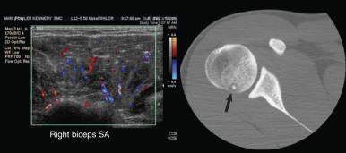 Fig. 7.11, Hyperemia on a color Doppler image. A 16-year-old male adolescent presented with shoulder pain, but the only abnormality evident on an initial shoulder ultrasound was prominent hyperemia in the deltoid muscle as seen on a color Doppler image (left image) . A computed tomography scan performed for further investigation revealed an osteoid osteoma (arrow) . SA, Short axis.