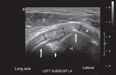Fig. 7.12, A shoulder ultrasound image showing a Hill-Sachs fracture. A long-axis (LA) sonogram of the subscapularis (subscap) tendon (S; black arrows) was performed. The subscapularis tendon (S) appears normal, as manifested by an organized fibrillar appearance. A focal hypoechoic area is present at the tendon insertion laterally (asterisk) that is related to an anisotropic artifact at the curved insertion of the tendon where the orientation of the transducer is off the 90-degree axis relative to the long axis of the distal tendon. The cortical bone of the humeral head (white arrows) deep to the tendon is manifested by a hyperechoic line with pronounced acoustic shadowing due to attenuation of the sound waves by bone. The bone is irregular at the site of an impaction fracture (short white arrow) . The deltoid muscle (D) shows a normal appearance, manifested by hypoechoic tissue with fine hyperechoic linear septations. H, Humeral head.