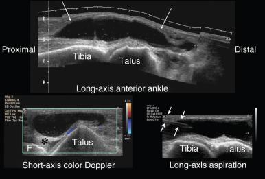 Fig. 7.13, Extensor digitorum longus tenosynovitis. A long-axis extended field of view image at the anterior aspect of the ankle (top image) shows an elongated fluid collection (arrows) . The collection is predominantly anechoic, containing a few low-level echoes. The short-axis color Doppler image (bottom left) shows that the posterior wall of the fluid collection is well defined. Increased through transmission of sound is evident posteriorly (asterisk) . No internal flow is evident on the color Doppler image. The findings confirm the diagnosis of a fluid collection. Ultrasound-guided aspiration of the fluid in the tendon sheath followed by injection of a steroid was performed (bottom right) . An 18-gauge needle (arrows) was used for the procedure. F, Fibula.