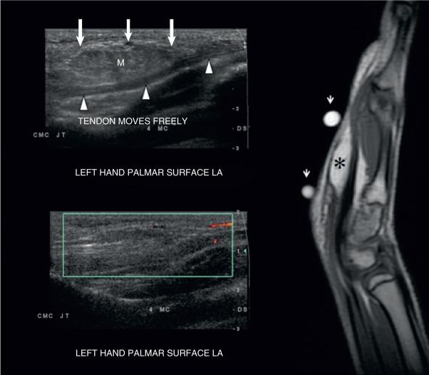 Fig. 7.14, An isoechoic mass without flow on a color Doppler image. A 13-year-old had a palpable mass on the palmar aspect of the hand. A long-axis (LA) sonogram (top left) shows a subtle isoechoic soft tissue mass (M, arrows) corresponding to the area of concern, causing slight displacement of the adjacent flexor tendon (arrowheads) . A color Doppler image (bottom left) shows no internal vascularity, confirming a hypovascular lesion. A sagittal T1-weighted spin-echo magnetic resonance image (MRI) (right) shows the lesion (asterisk) has a high-intensity signal, confirming the diagnosis of a lipoma. Markers were positioned over the area of clinical concern prior to the MRI scan (small arrows) .