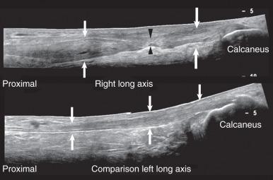 Fig. 7.15, The sonographic appearance of tendons. An extended field of view long-axis sonogram of a normal Achilles tendon (bottom, arrows) shows an organized fibrillar appearance. A long-axis view of a completely torn Achilles tendon (top, arrows) shows focal discontinuity of tendon fibers (black arrowheads) in the watershed zone several centimeters proximal to the calcaneal insertion. The proximal tendon is swollen and hypoechoic as a result of intrasubstance hemorrhage and edema. The distalmost aspect of the tendon is thickened and mildly hypoechoic, related to a background of tendinosis.