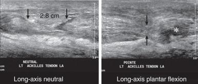 Fig. 7.16, A complete tear of the Achilles tendon is shown with dynamic imaging. The long-axis (LA) view of the Achilles tendon (left image) with the foot in a neutral position shows a 2.8-cm gap between the edges of the torn tendon fibers (arrows) . In plantar flexion (right image) , the tendon fibers co-apt (arrows) . An ill-defined hypoechoic area is now evident, corresponding to a refraction artifact (asterisk) .