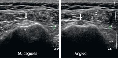 Fig. 7.17, Anisotropy. A short-axis view of the long head of the biceps tendon (arrow, left) shows the normal echogenic appearance of the tendon when the ultrasound probe is oriented 90 degrees to the long axis of the tendon. The tendon becomes artifactually hypoechoic as a result of anisotropy when the probe is angled off the 90-degree axis (arrow; right) . D, Deltoid; H, humeral head.