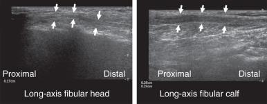 Fig. 7.18, Ultrasound images of the peroneal nerve. The long-axis view (left) of the common peroneal nerve just distal to the level of the fibular head shows a normal appearance of the nerve appearing as a fine fibrillar hypoechoic structure (arrows) . In the proximal calf (right) , the nerve becomes thickened but retains its fibrillar structure (arrows) .