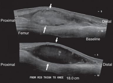 Fig. 7.19, Thigh hematoma illustrating overlap of the appearance of complex cystic fluid collections and solid lesions. An extended field of view long-axis sonogram of the anterior thigh (top) shows a large isoechoic mass corresponding to an acute hematoma (arrows) , which could be easily misconstrued as a solid soft tissue mass. A long-axis sonogram of the same area (bottom) 2 weeks later shows the normal evolution of a hematoma, now manifested as a complex fluid collection containing a few low-level echoes (arrows) .