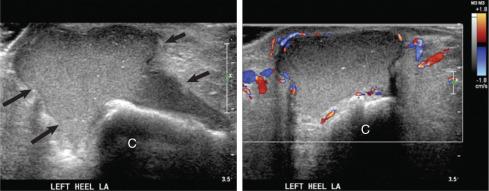 Fig. 7.20, A soft tissue abscess mimicking a solid mass lesion in a diabetic patient with a heel abscess. A long-axis (LA) sonogram (left) shows an irregular isoechoic mass (arrows) superficial to the calcaneus (C) with mobile internal echoes at real time (not shown). A long-axis color Doppler image of the lesion (right) shows peripheral hyperemia.