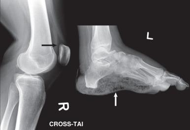 Fig. 7.2, Radiographic densities. A cross-table lateral radiograph of the knee (left) shows a fat-fluid level (arrow) associated with a lipohemarthrosis indicative of an intraarticular fracture corresponding to marrow fat that has escaped from the fracture into the joint space. The marrow fat layers superficially to the dependent red blood cells in the joint and appears more lucent than muscle in the soft tissues. A lateral radiograph of the foot (right) in a patient with diabetes shows extensive lucencies in the soft tissues of the plantar soft tissues of the foot (arrow) associated with a gas-forming infection. Bones and calcified structures have the greatest density on radiographs and appear white. Muscle tissue is light gray, fatty tissue is dark gray, and gas is black.