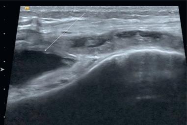 Fig. 7.21, Ultrasound at the level of the suprapatellar bursa demonstrates a heterogeneous, thick-walled effusion most compatible with complex suprapatellar synovitis.
