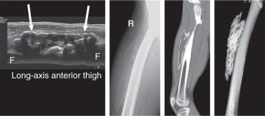 Fig. 7.22, Soft tissue calcifications on an ultrasound image. The patient has myositis ossificans. A long-axis sonogram of the anterior thigh (left) shows extensive calcification ( arrows ; F, femur). A lateral radiograph of the femur (middle left) confirms the presence of peripheral zonal calcification in the anterior soft tissues of the thigh. A sagittal multiplanar reformatted computed tomography (CT) scan (middle right) and three-dimensional CT reformat (right) confirm the diagnosis of myositis ossificans.