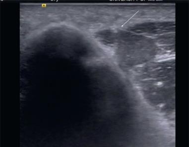 Fig. 7.24, Dynamic ultrasound of through the cubital tunnel demonstrates an enlarged and hypoechoic ulnar nerve, most compatible with ulnar neuritis.