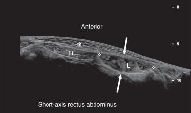 Fig. 7.25, Extended field of view ultrasound. The large field of view short-axis image of the anterior abdominal wall optimally displays enlargement and heterogeneous decreased echogenicity in the left rectus abdominis muscle (L; arrows) associated with a complete tear. The right rectus abdominis muscle (R) is normal in comparison. The asterisk denotes subcutaneous tissues.