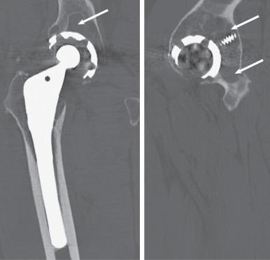 Fig. 7.27, A computed tomography image of a hip arthroplasty with a metal algorithm. Coronal (left) and sagittal (right) multiplanar reformats of the right hip show a cementless right total hip arthroplasty. A large irregular area of osteolysis is present in the periprosthetic acetabulum as a result of particle disease (arrows) .