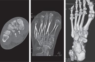 Fig. 7.28, Computed tomography (CT) reformats of second through fourth metatarsal fractures. Radiographs indicated a solitary fourth metatarsal fracture (not shown). A transverse CT image (left) through the midfoot with curved coronal multiplanar (middle) and three-dimensional volume-rendered (right) reformats confirm comminuted minimally displaced fractures involving the second and third metatarsal bases (arrows) .