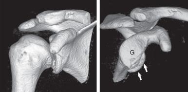 Fig. 7.29, Volume-rendered computed tomography reformats with segmentation. The entire right shoulder joint is displayed (left) . Using a segmentation technique (right) , the humeral head was removed and the image was rotated to show the glenoid (G) en face for better visualization of the Bankart fracture (arrows).