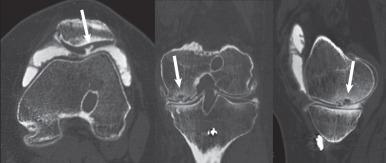 Fig. 7.30, A computed tomography (CT) arthrogram of the knee. CT images of the knee are shown after injection of iodinated contrast material. The patellofemoral cartilage is well visualized, with contrast outlining a large cartilage flap along the lateral patellar facet (arrow) on a transverse multiplanar reformat (left) . Sagittal (right) and coronal (middle) multiplanar reformats demonstrate areas of full-thickness cartilage loss along the posterior weight-bearing surface of the medial femoral condyle with subchondral sclerosis and cystic change (arrows) .